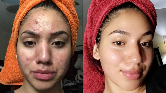 Teen shares how she cleared her severe acne using a one-ingredient product