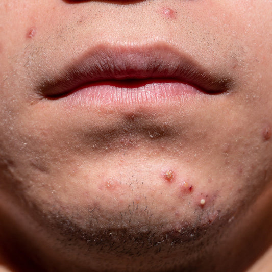 Acne in men: causes and natural skincare for face, back and shoulders