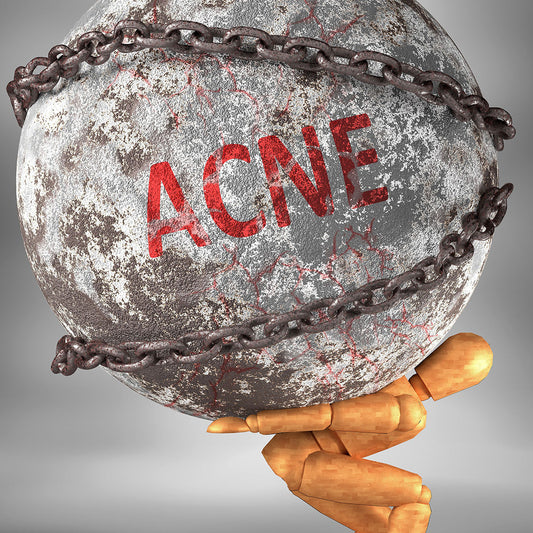 Woman touching her face, illustrating how stress and acne are connected