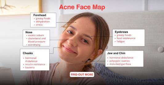 acne face map showing breakouts by facial zone
