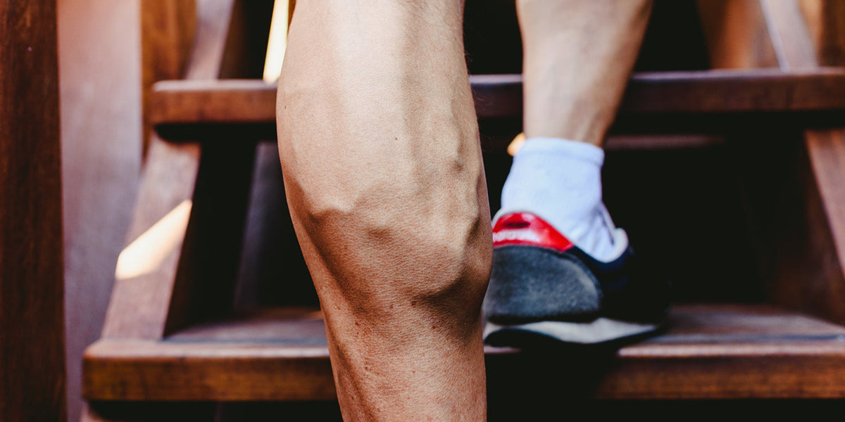 varicose veins and exercise