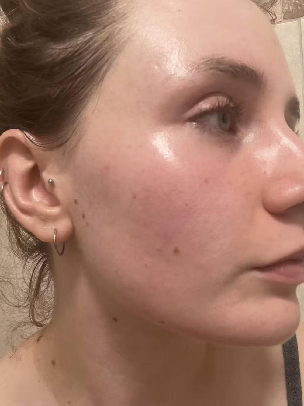 acne UK keep