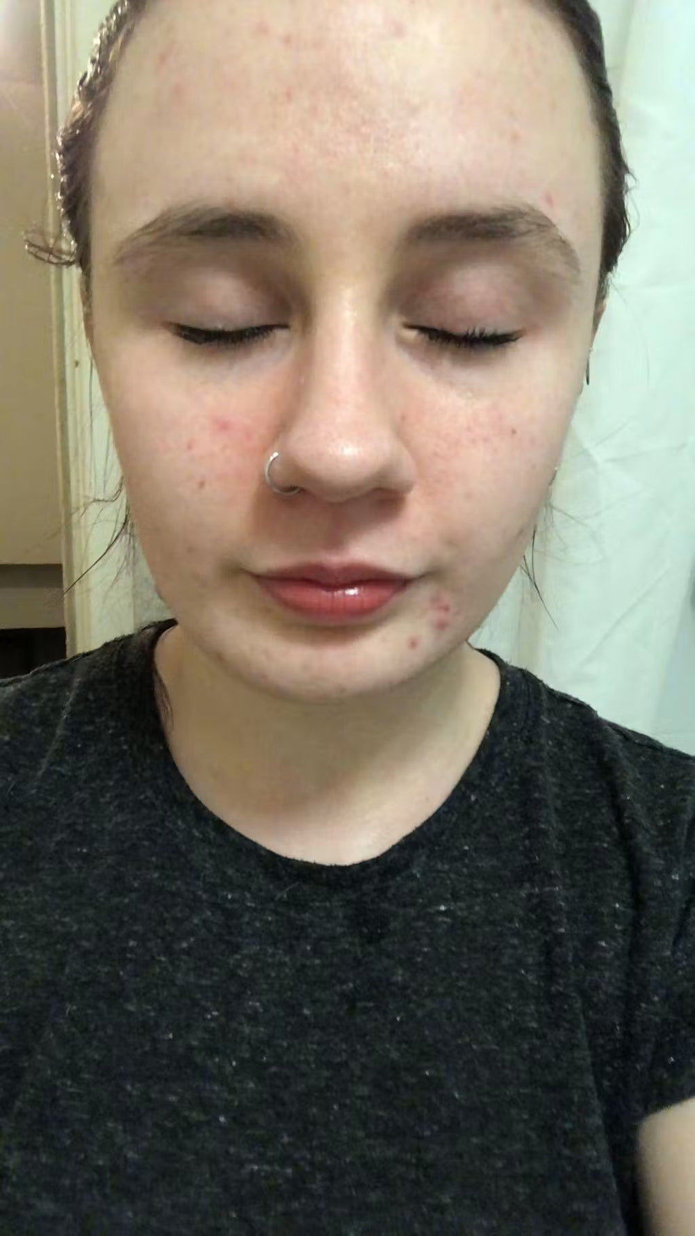 acne UK keep