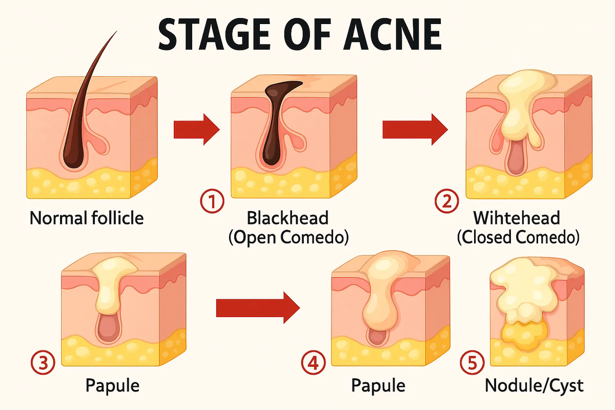 How we beat the acne of over 25 000 teenagers | InaEssentials.UK