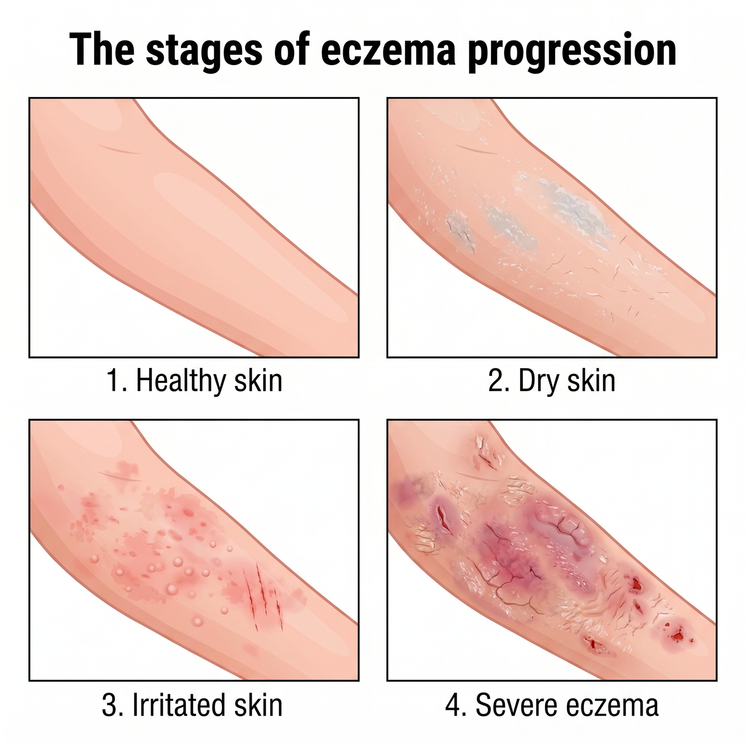 eczema_4stages