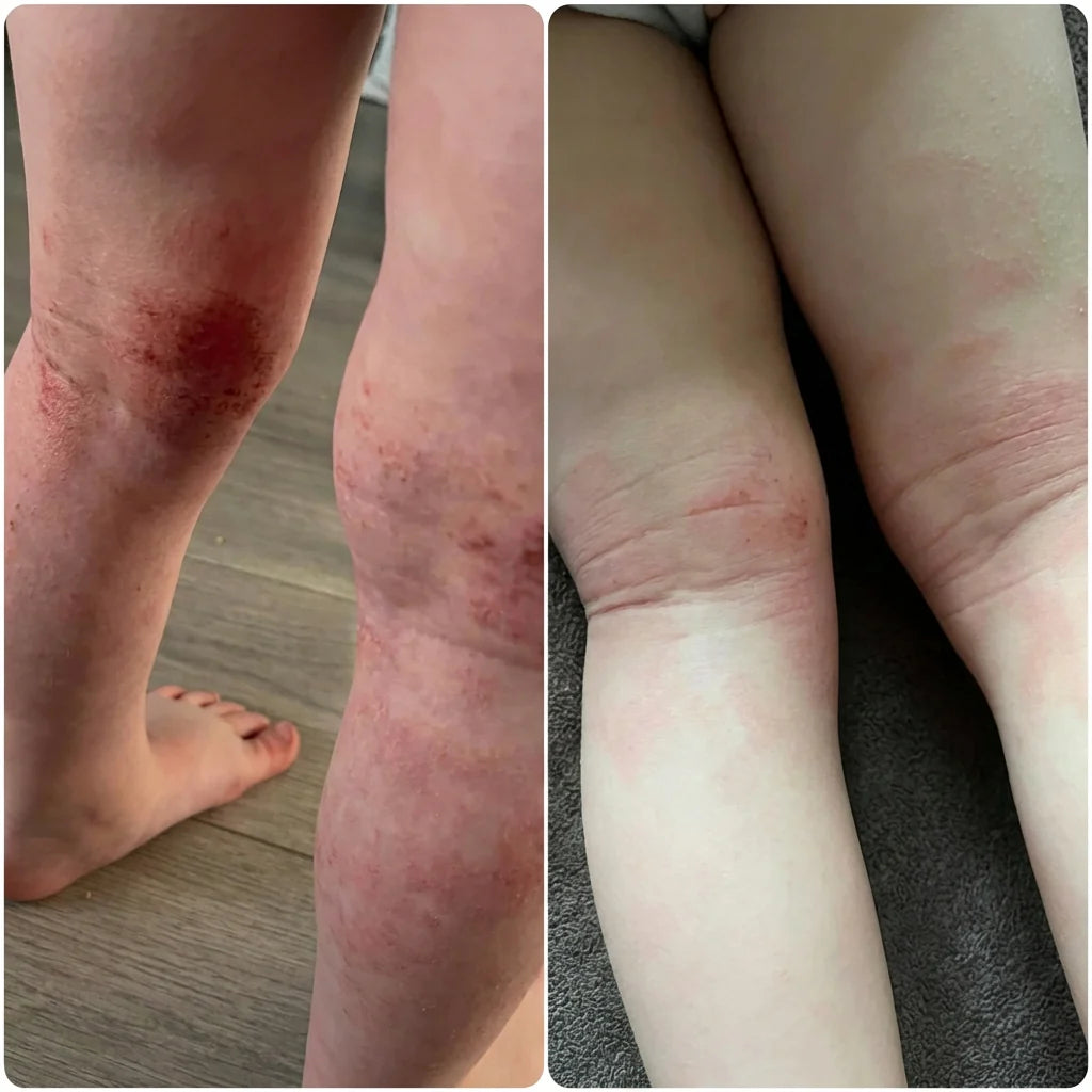 friends child eczema before after